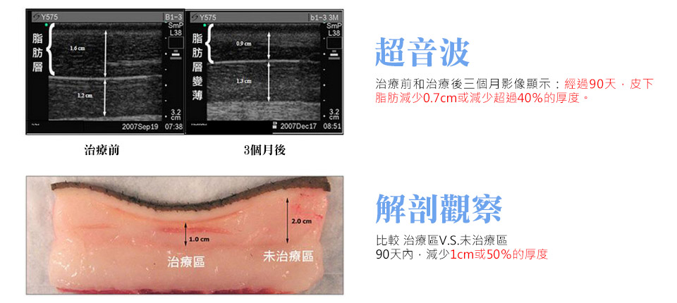 酷塑冷凍減脂可減少27％脂肪厚度