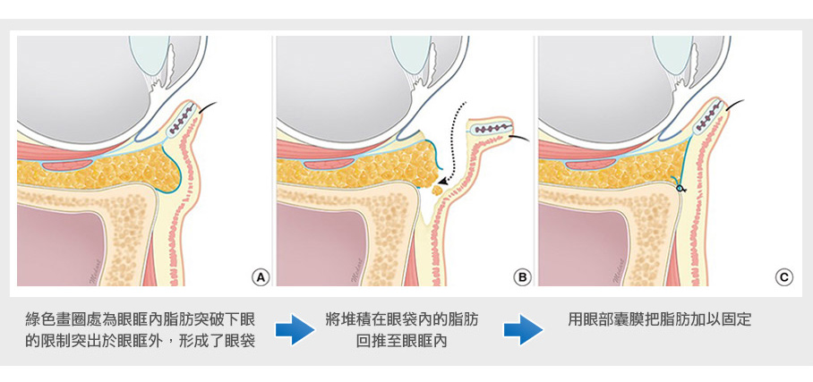 無痕眼袋手術方法解頗圖