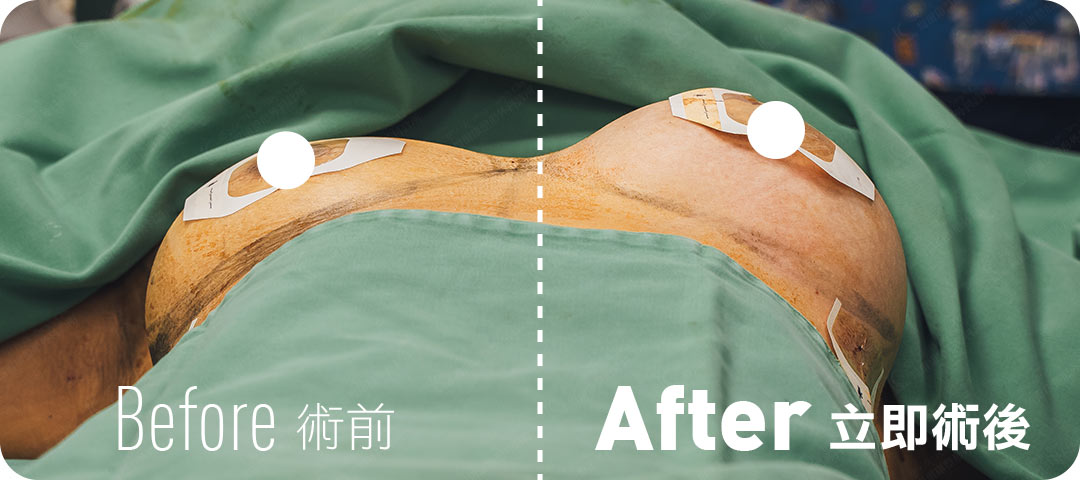 周爾康醫師自體脂肪隆乳術中立即效果-08
