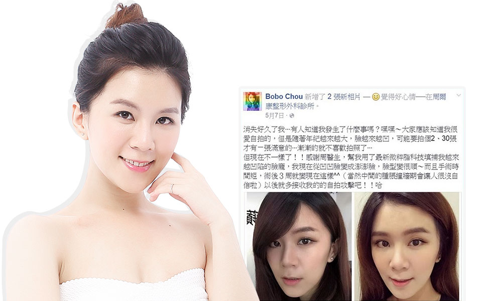 微粹脂自體脂肪豐頰手術