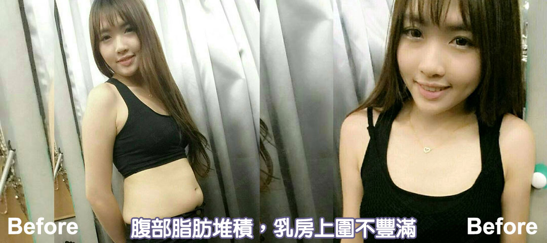 周爾康醫師自體脂肪隆乳手術案例術前生活照-01