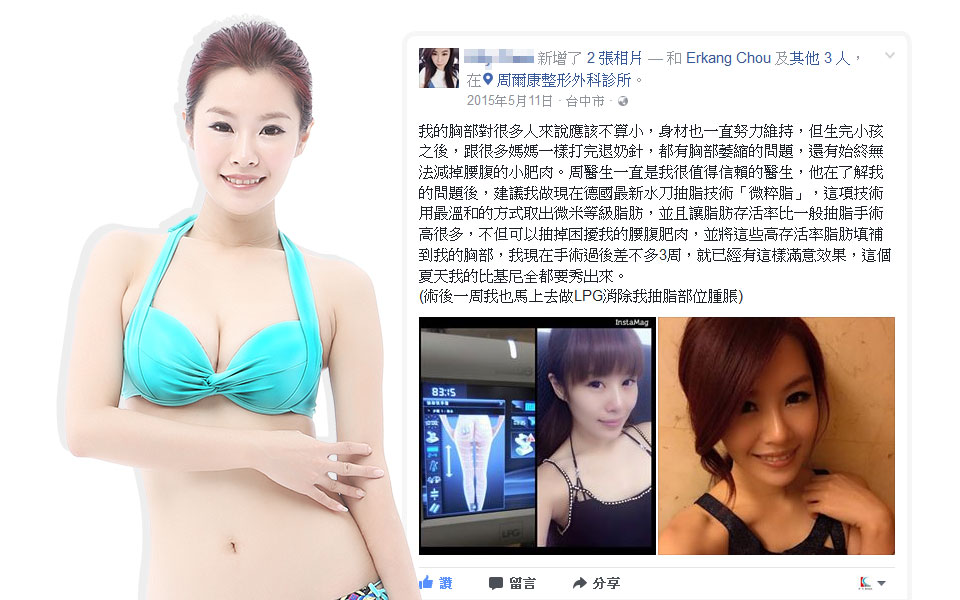 周爾康醫師自體脂肪隆乳案例產後媽媽的自體脂肪隆乳手術心得