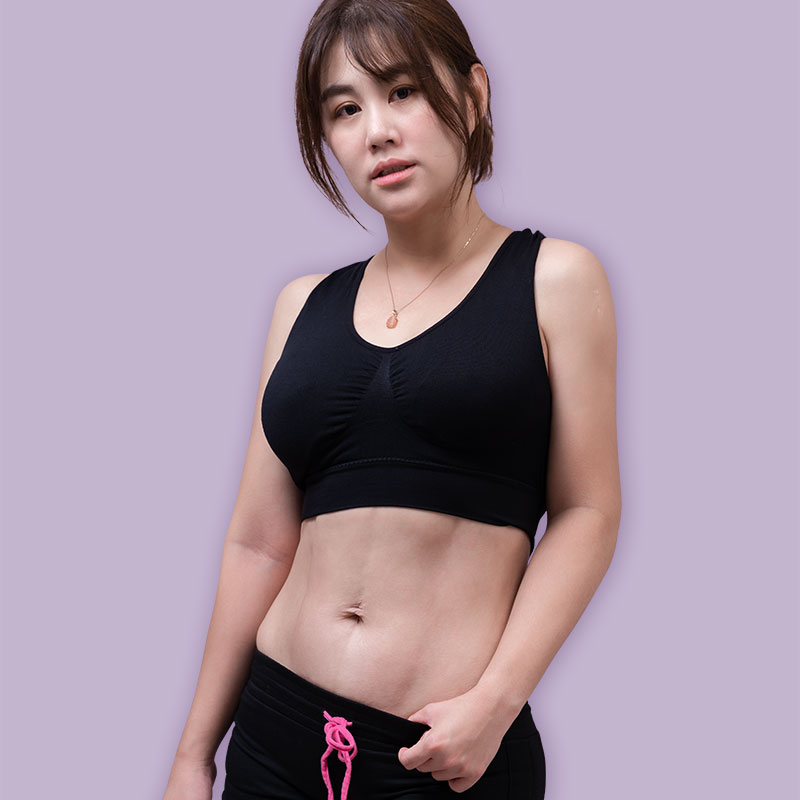 腹部抽脂術後腹部平坦,人魚線顯現-04 腹部抽脂術後腹部平坦,人魚線顯現-04