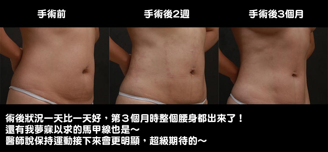 周爾康醫師威塑腹部抽脂腹腰環抽雕塑馬甲線+自體脂肪豐胸案例-09