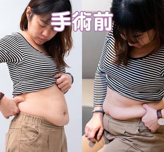 周爾康醫師威塑腹部抽脂腹腰環抽雕塑馬甲線+自體脂肪豐胸案例-11