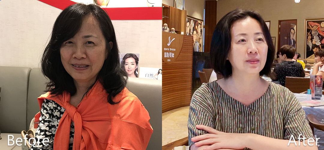 周爾康整形外科診所內視鏡前額拉皮案例術前術後對比照