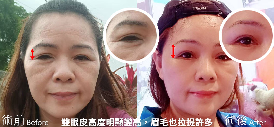 周爾康整形外科內視鏡前額拉皮案例術前術後照抬頭紋對比