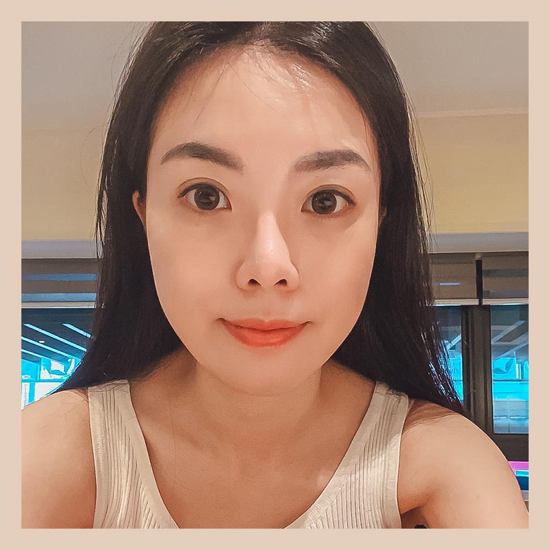 隱痕眼袋手術術後生活照-01 隱痕眼袋手術術後生活照-01