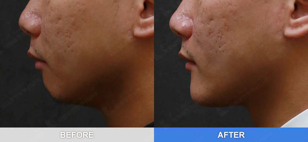 周爾康醫師墊下巴手術案例