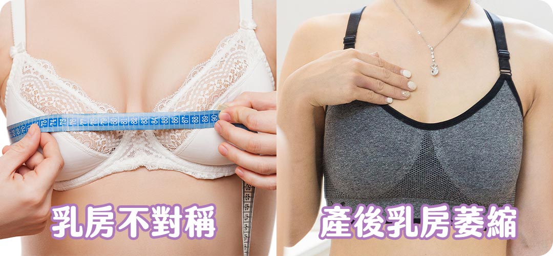 周爾康醫師自體脂肪隆乳隆乳困擾點-02