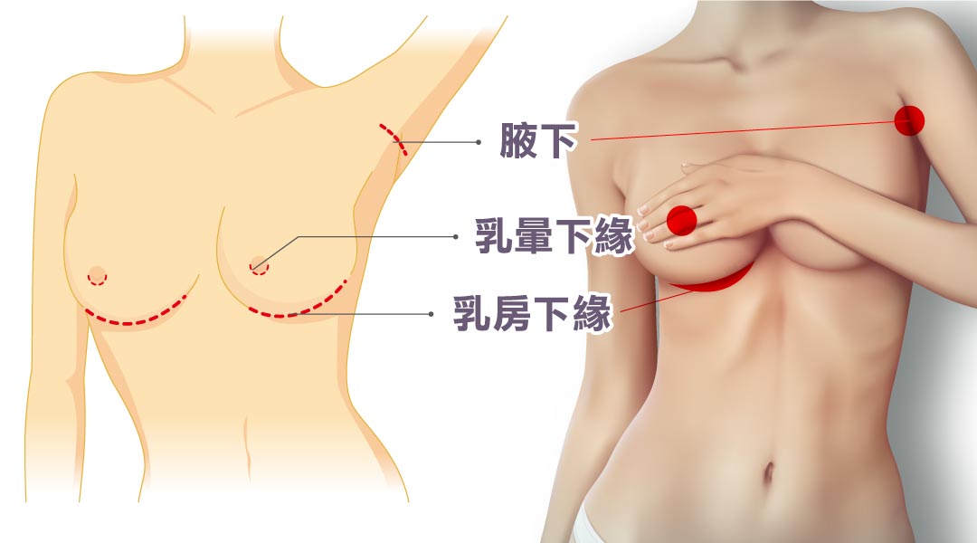 隆乳手術切口｜乳暈下緣｜乳房下緣｜腋下