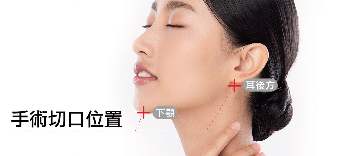 雙下巴抽脂手術切口位置 雙下巴抽脂手術切口位置