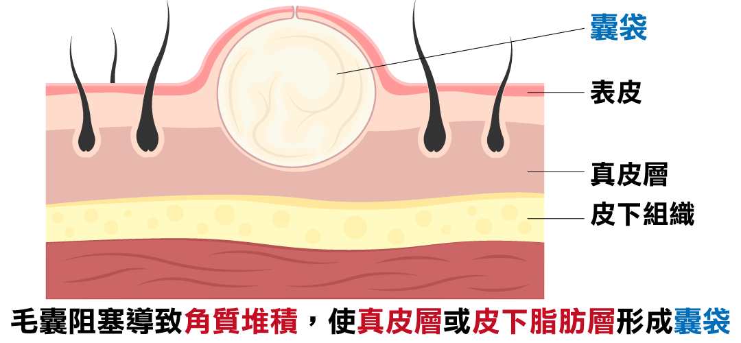 粉瘤結構圖