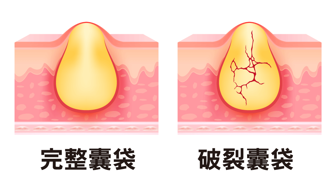 粉瘤會不斷復發？