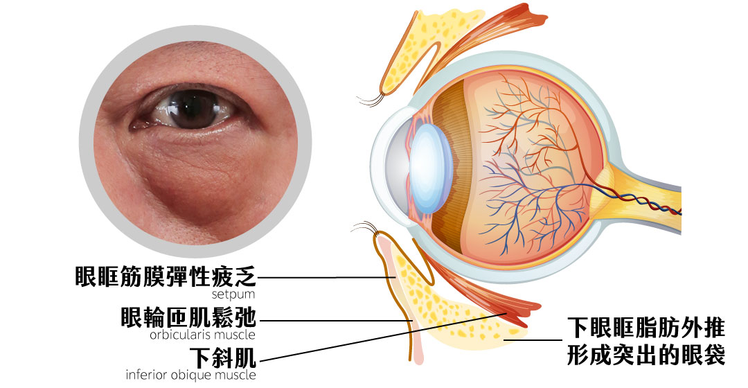 眼袋形成原因