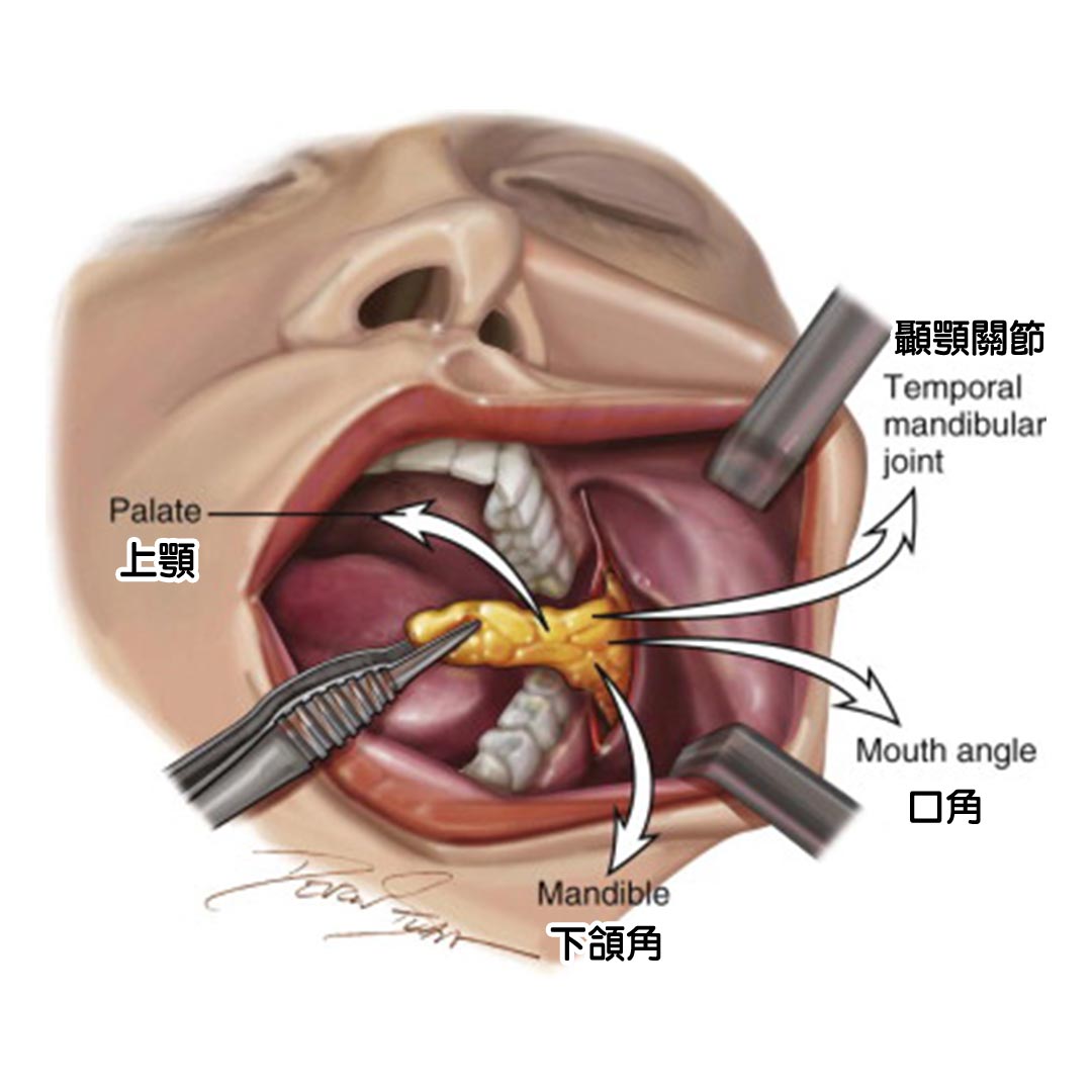 口內取脂手術示意圖-01