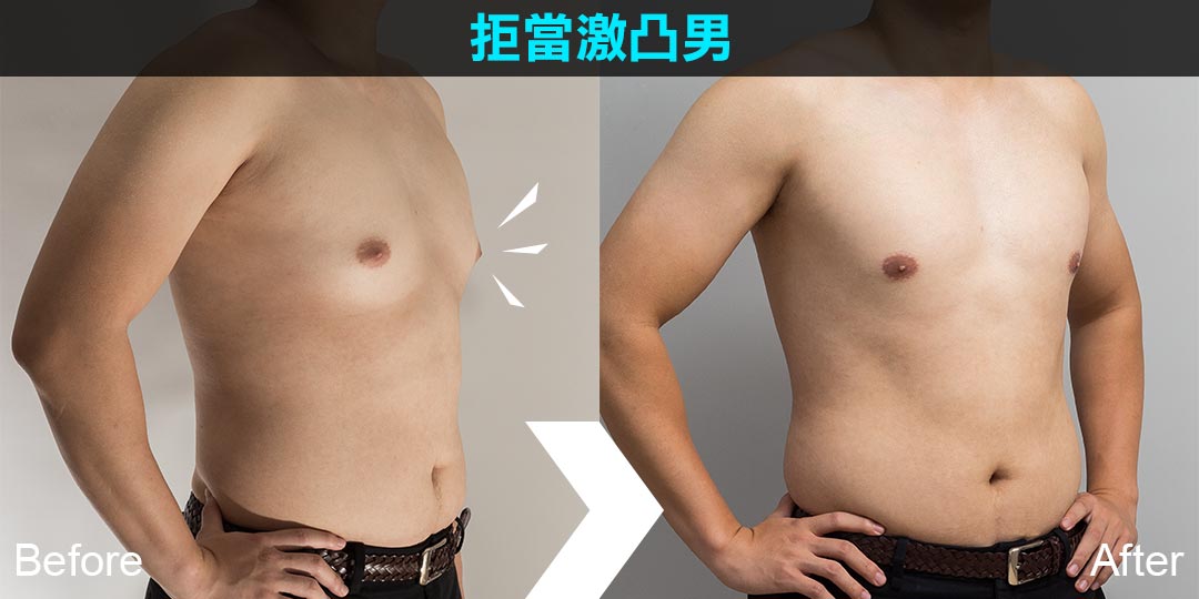 周爾康醫師男性女乳症治療案例手術後