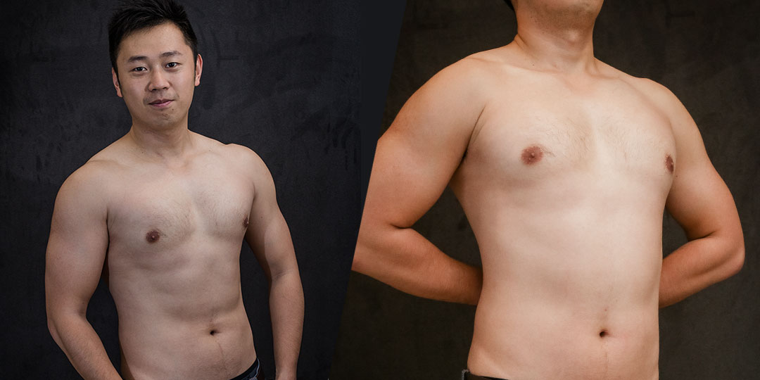 周爾康醫師男性女乳症治療案例術後照