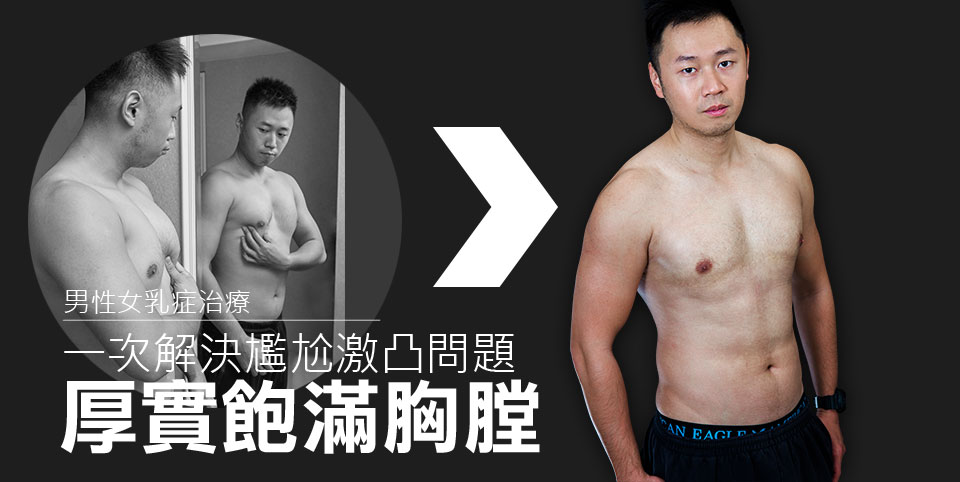 男性女乳症
