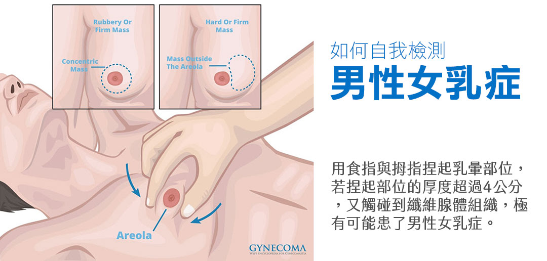 男性女乳症自我檢測方式