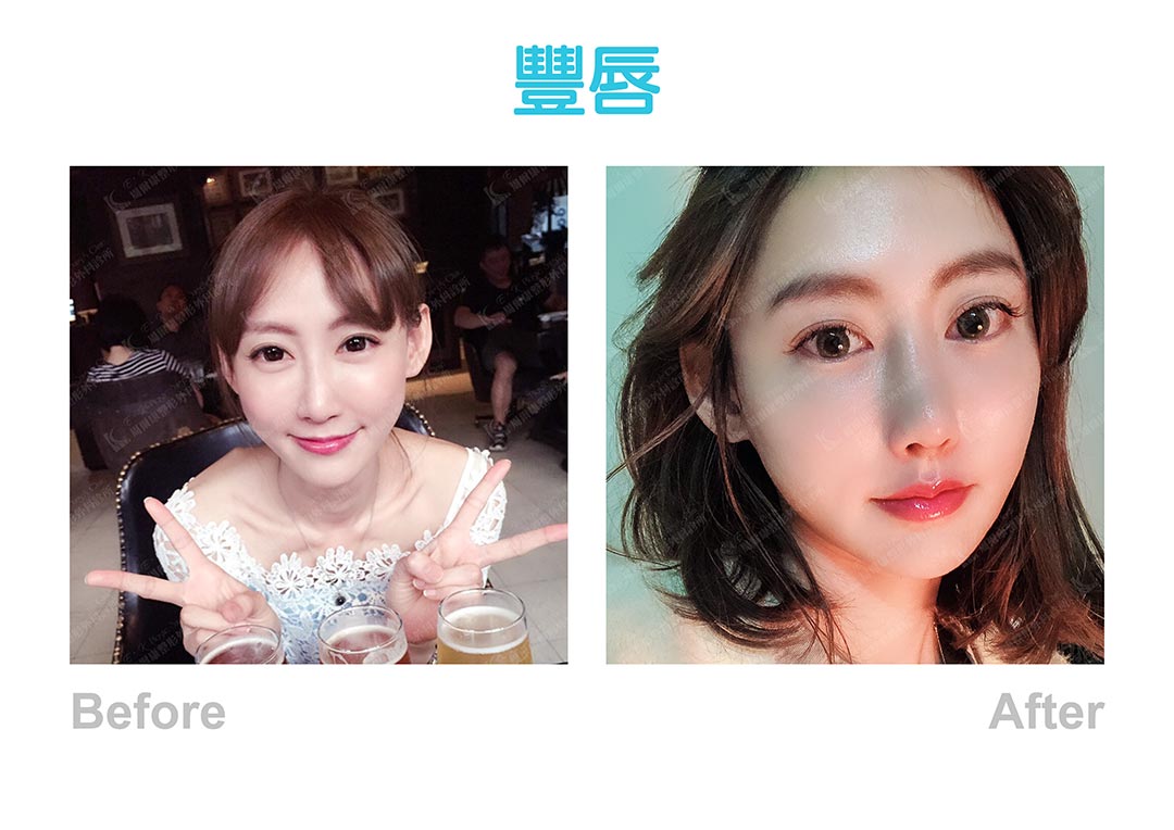 玻尿酸豐唇