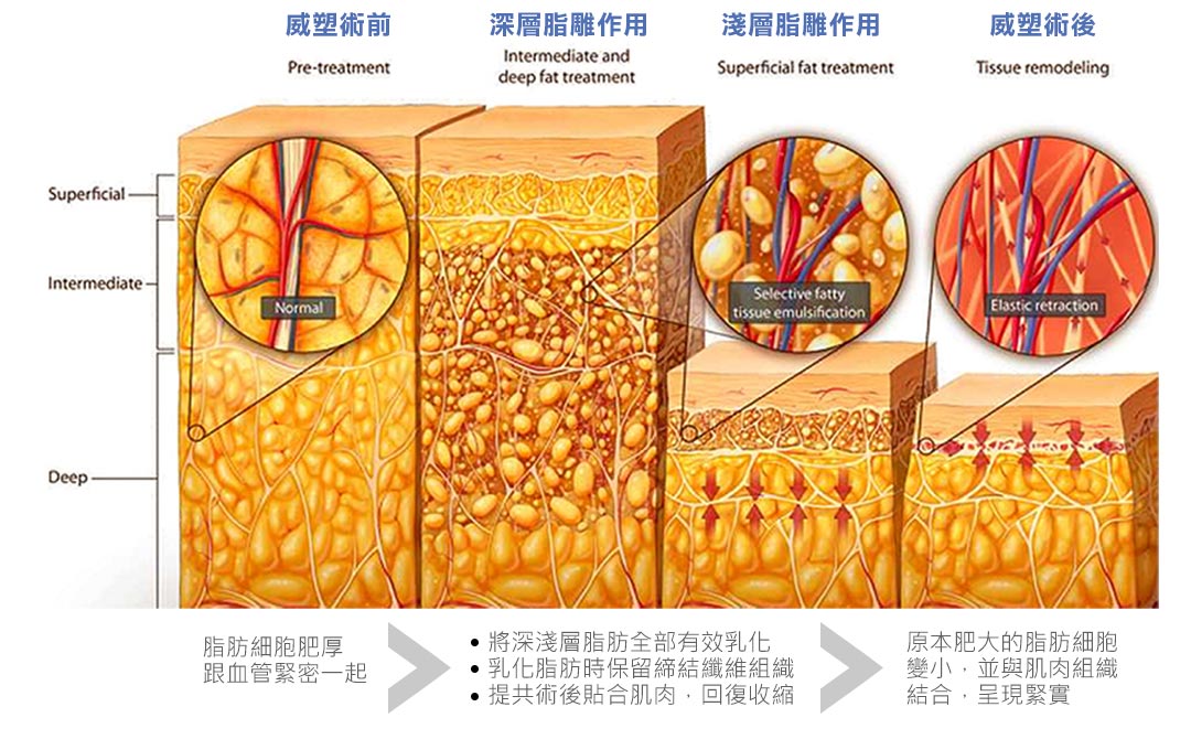 台中抽脂VASER威塑抽脂原理說明圖示-01 台中抽脂VASER威塑抽脂原理說明圖示-01
