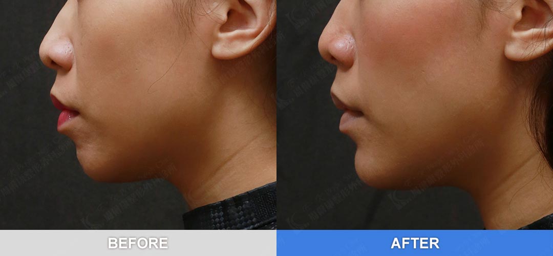 周爾康醫師墊下巴手術案例