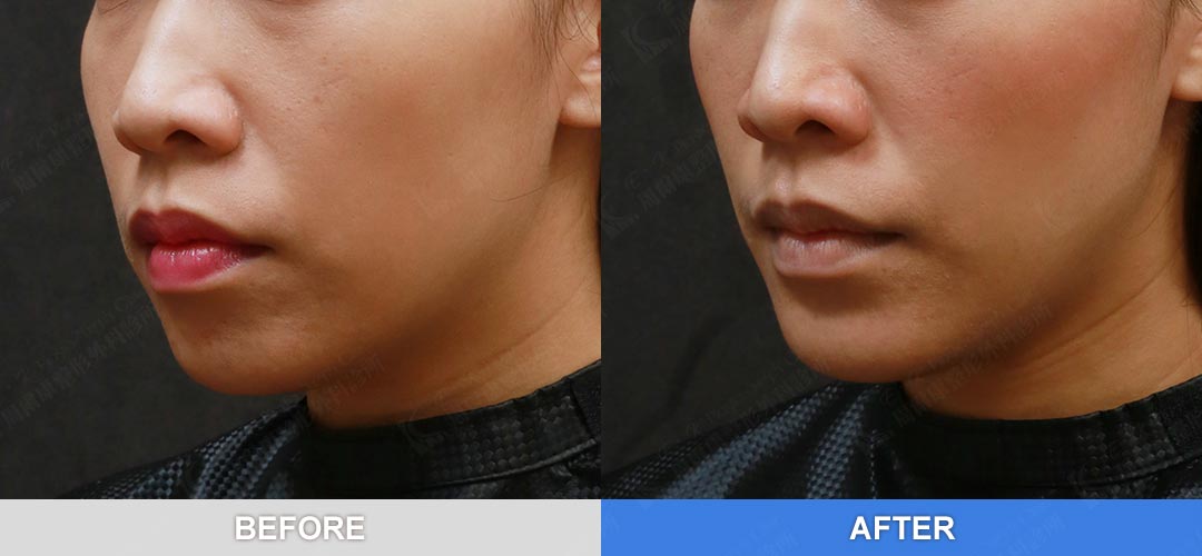 周爾康醫師墊下巴手術案例