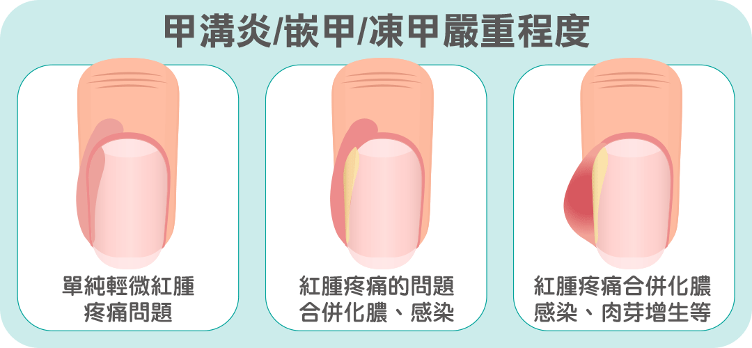 甲溝炎/嵌甲/凍甲嚴重程度