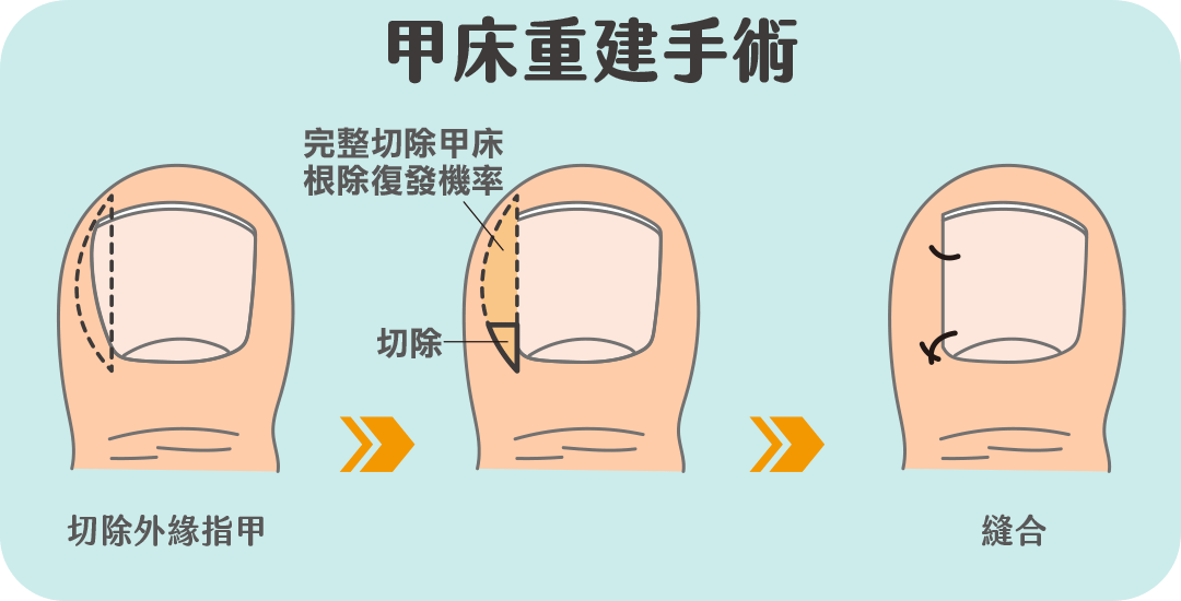 甲床重建手術治療甲溝炎