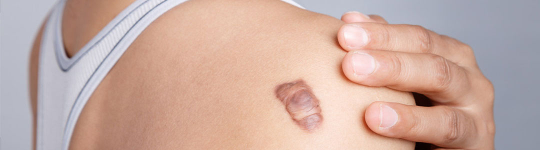蟹足腫、肥厚性疤痕有哪些治療方法