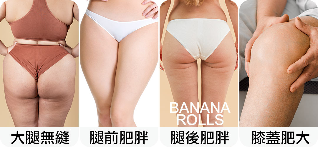 大腿抽脂困擾｜大腿無縫｜腿前肥胖｜腿後肥胖(Banana Rolls)｜膝蓋肥大