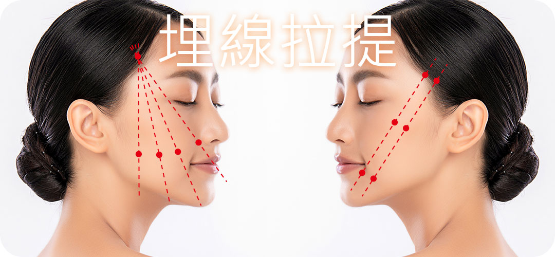 埋線拉提原理是什麼