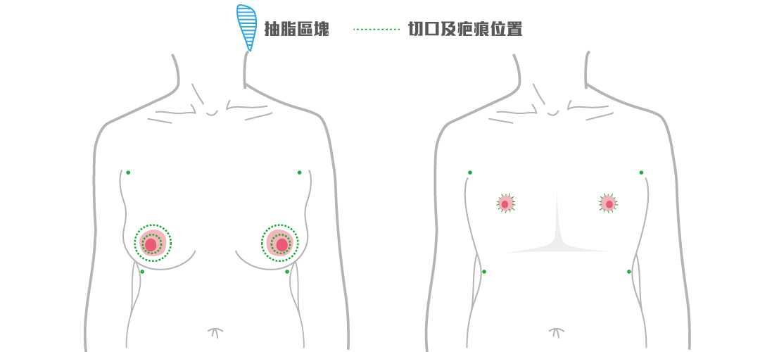 平胸手術方式：乳暈環切平胸手術