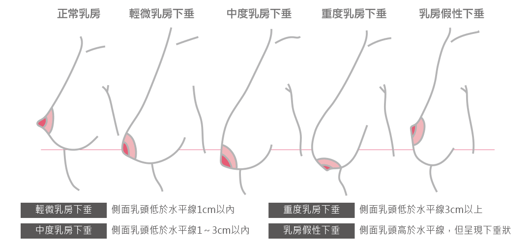 平胸手術方式比較