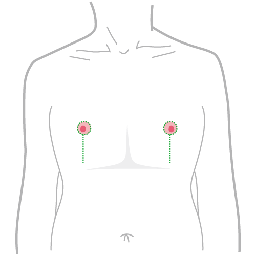 平胸手術方式：棒棒糖式平胸手術