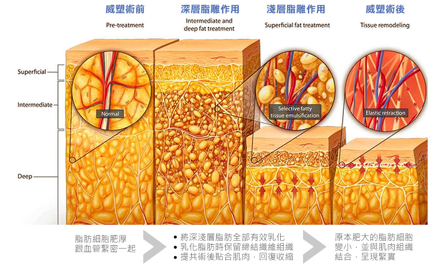 VASER威塑音波氣泡震散脂肪團塊示意圖-01