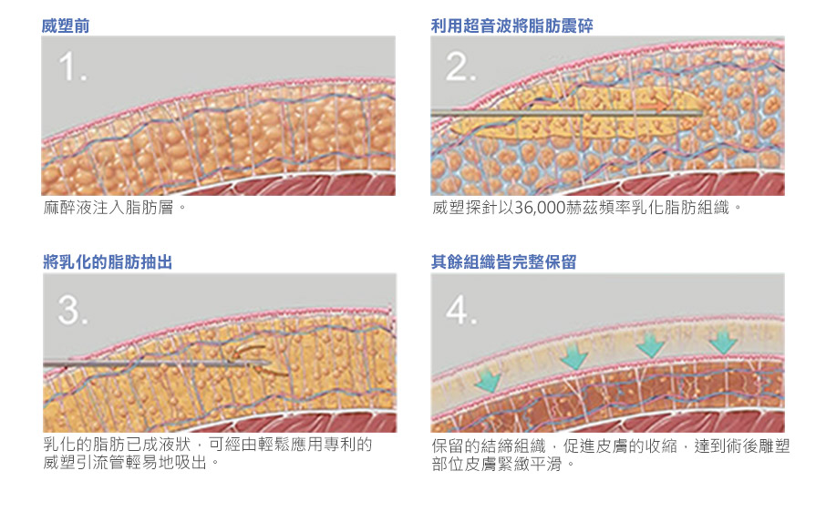 VASER威塑音波氣泡震散脂肪團塊示意圖-02