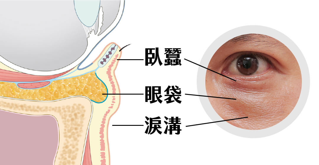 眼袋成因