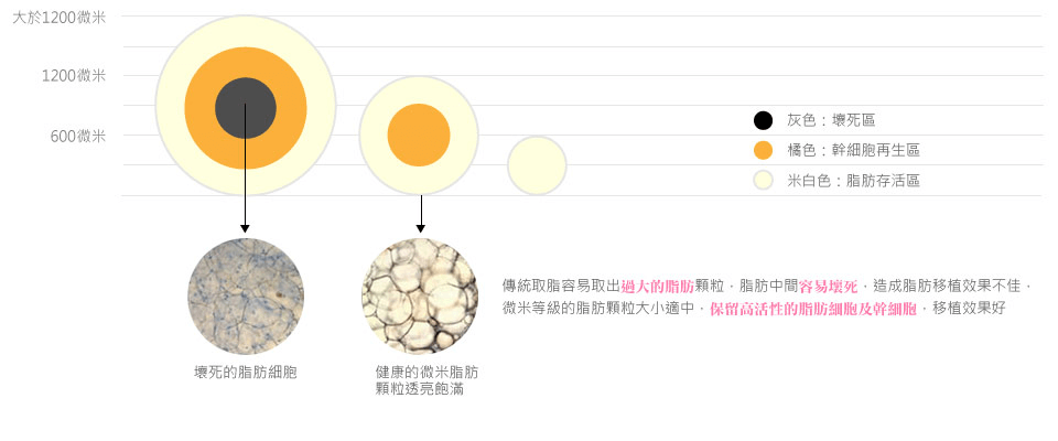 微粹脂手術與傳統抽脂手術比較
