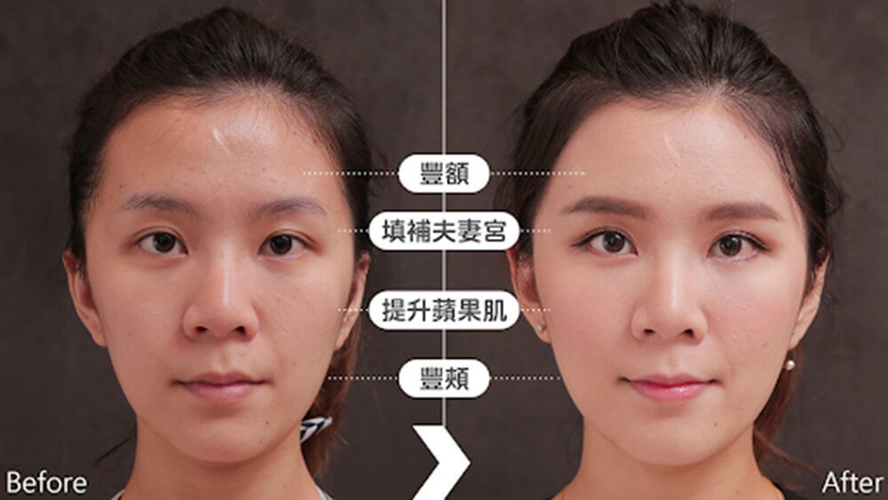 全臉補脂手術